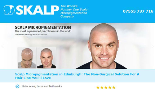 scalp micropigmentation specialists in Edinburgh Scotland